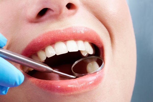 Reasons You Need a Dental Filling